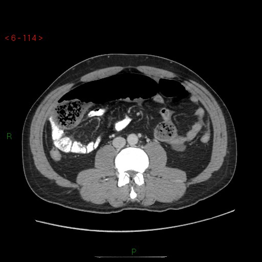 File:Closed loop obstruction and appendicular stump mucocele (Radiopaedia 54014-60163 A 64).jpg