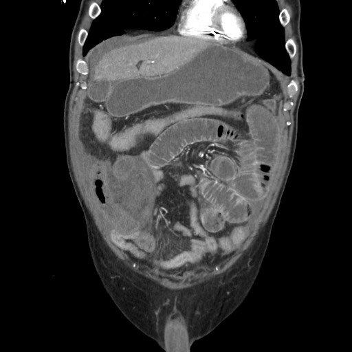 File:Closed loop obstruction due to adhesive band, resulting in small bowel ischemia and resection (Radiopaedia 83835-99023 C 37).jpg