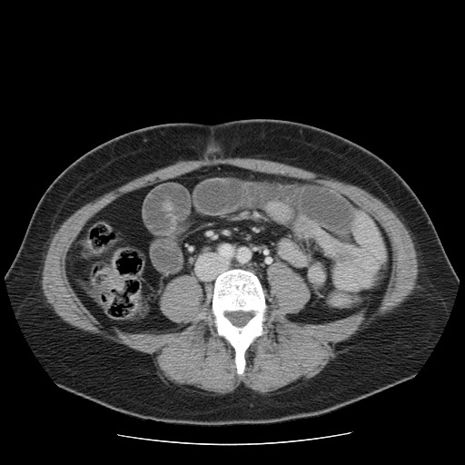 File:Closed loop small bowel obstruction (Radiopaedia 65403-74451 A 47).jpg