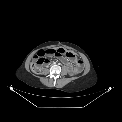 Closed loop small bowel obstruction (Radiopaedia 68471-78022 A 57).jpg
