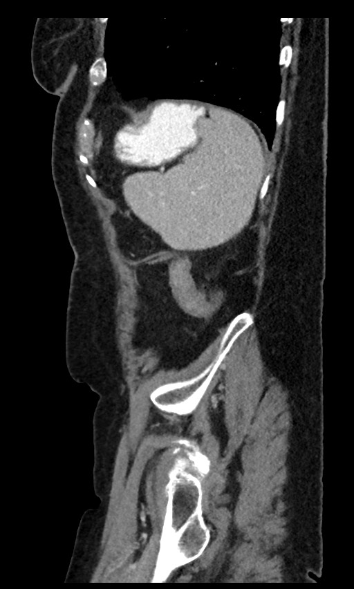 Closed loop small bowel obstruction - adhesions (Radiopaedia 59269-66611 C 21).jpg