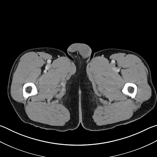 Closed loop small bowel obstruction - internal hernia (Radiopaedia 57806-64778 B 147).jpg