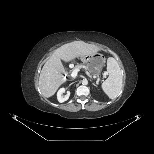 Closed loop small bowel obstruction - internal hernia (Radiopaedia 65402-74450 A 36).jpg
