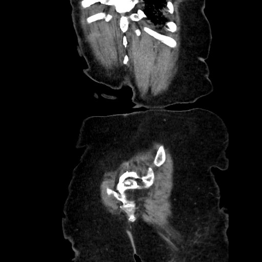 File:Closed loop small bowel obstruction due to adhesive band, with intramural hemorrhage and ischemia (Radiopaedia 83831-99017 C 113).jpg