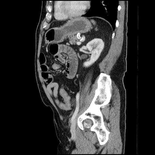 Closed loop small bowel obstruction due to adhesive band - U-shaped loop (Radiopaedia 83829-99012 C 25).jpg
