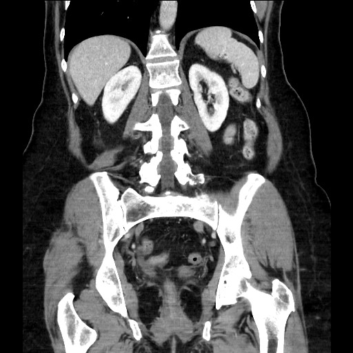 Closed loop small bowel obstruction due to adhesive bands - early and late images (Radiopaedia 83830-99014 B 86).jpg
