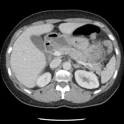 Closed loop small bowel obstruction due to trans-omental herniation (Radiopaedia 35593-37109 A 29).jpg