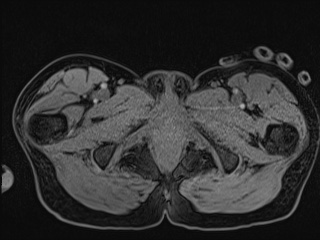 Closed loop small bowel obstruction in pregnancy (MRI) (Radiopaedia 87637-104031 G 36).jpg
