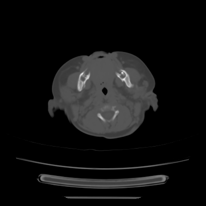 File:Cloverleaf skull (Radiopaedia 91901-109710 Axial bone window 31).jpg