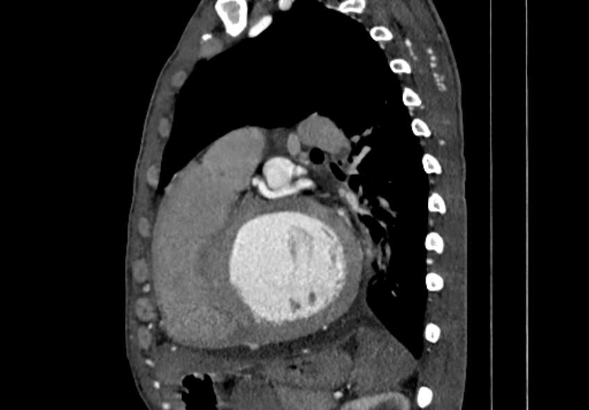 Coarctation of aorta with aortic valve stenosis (Radiopaedia 70463-80574 B 115).jpg