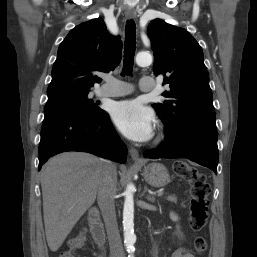 Coarctation of the aorta (Radiopaedia 17427-17116 A 45).jpg