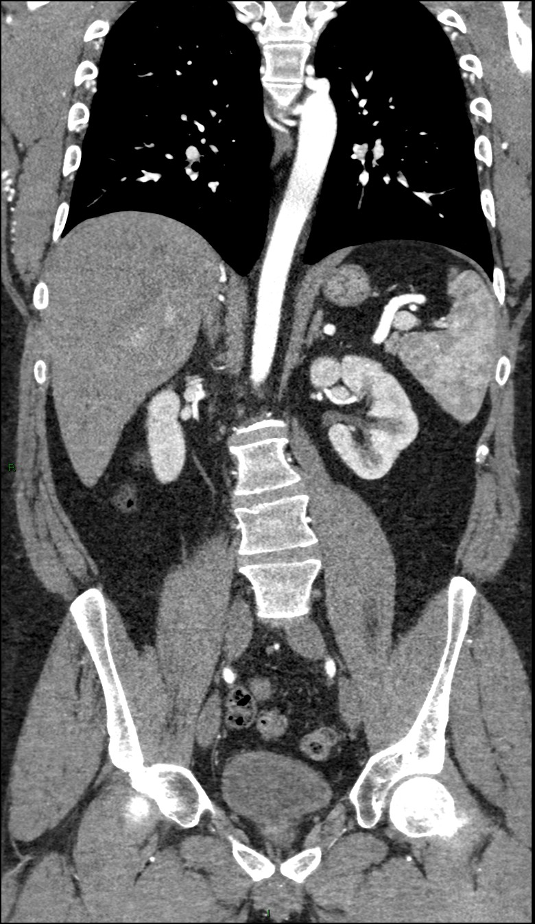 Coarctation of the aorta (Radiopaedia 74632-88521 B 143).jpg