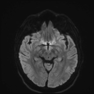File:Cochlear incomplete partition type III associated with hypothalamic hamartoma (Radiopaedia 88756-105498 Axial DWI 58).jpg