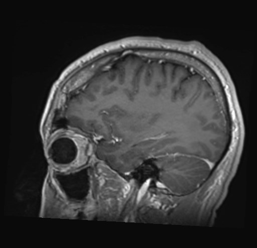 Cochlear incomplete partition type III associated with hypothalamic hamartoma (Radiopaedia 88756-105498 Sagittal T1 C+ 16).jpg