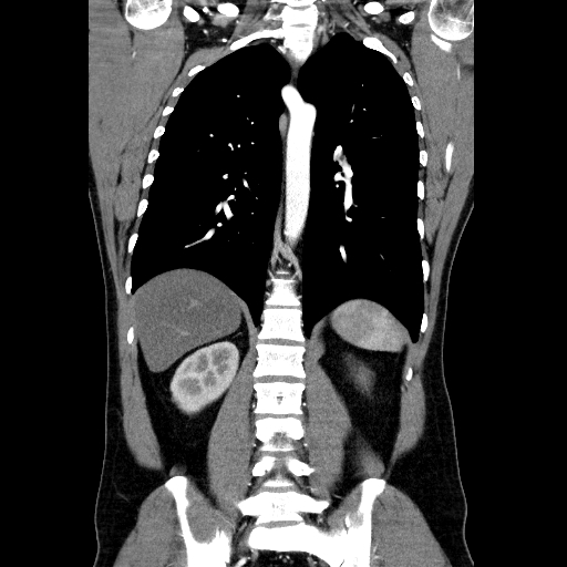 File:Codominant double aortic arch (Radiopaedia 56012-62637 B 32).jpg
