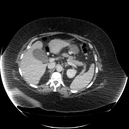 File:Collection due to leak after sleeve gastrectomy (Radiopaedia 55504-61972 A 27).jpg