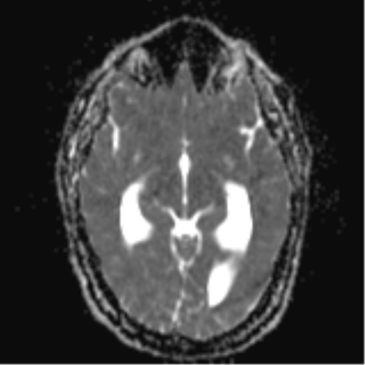 File:Colloid cyst (Radiopaedia 44510-48181 Axial ADC 12).png