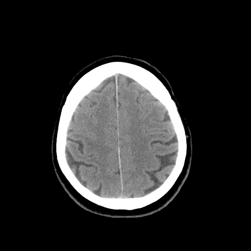 File:Colloid cyst (large) (Radiopaedia 34415-35734 Axial non-contrast 46).png