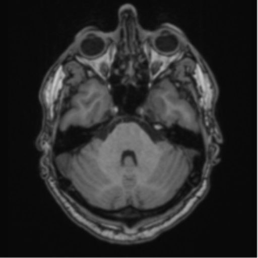 File:Colloid cyst of the third ventricle (Radiopaedia 86571-102662 Axial T1 23).png