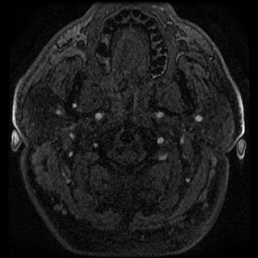 File:Colloid cyst with anterior communicating artery aneurysm (Radiopaedia 33901-35091 Axial MRA 11).jpg