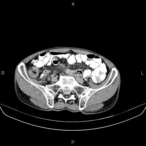 File:Colon adenocarcinoma - hepatic flexure (Radiopaedia 85635-101395 Axial C+ delayed 69).jpg