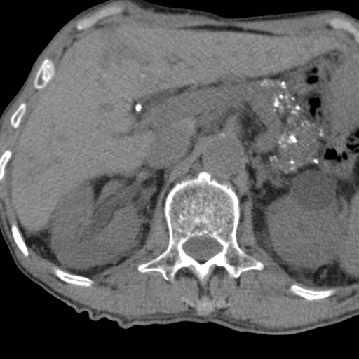 File:Colon cancer with calcified liver metastasis (Radiopaedia 74423-85309 Axial non-contrast 29).jpg