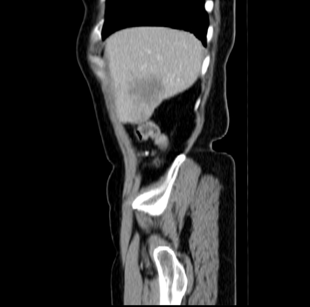 Colon carcinoma with hepatic metastases (Radiopaedia 29477-29961 C 8).jpg