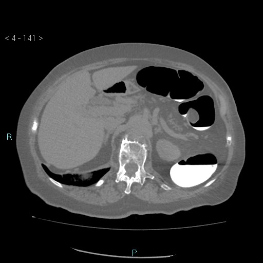 Colonic lipomas (Radiopaedia 49137-54244 Axial bone window 63).jpg
