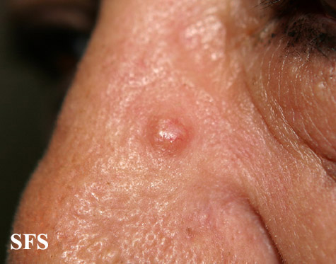 File:Fibrofolliculoma (Dermatology Atlas 2).jpg