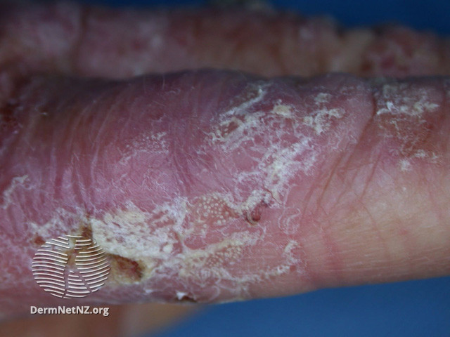 Intraepidermal carcinoma (DermNet NZ lesions-scc-in-situ-2971).jpg