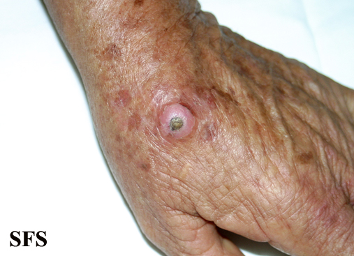File:Keratoacanthoma (Dermatology Atlas 56).jpg