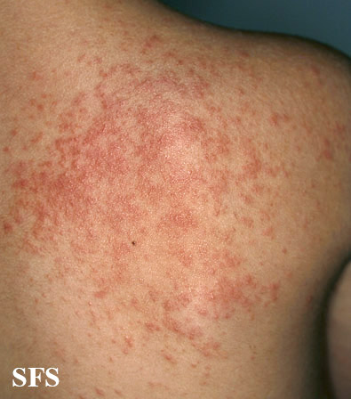File:Miliaria (Dermatology Atlas 13).jpg