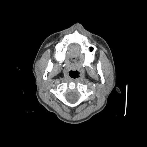 File:Nasal pyogenic granuloma (lobular capillary hemangioma) (Radiopaedia 85536-101244 C 1).jpg