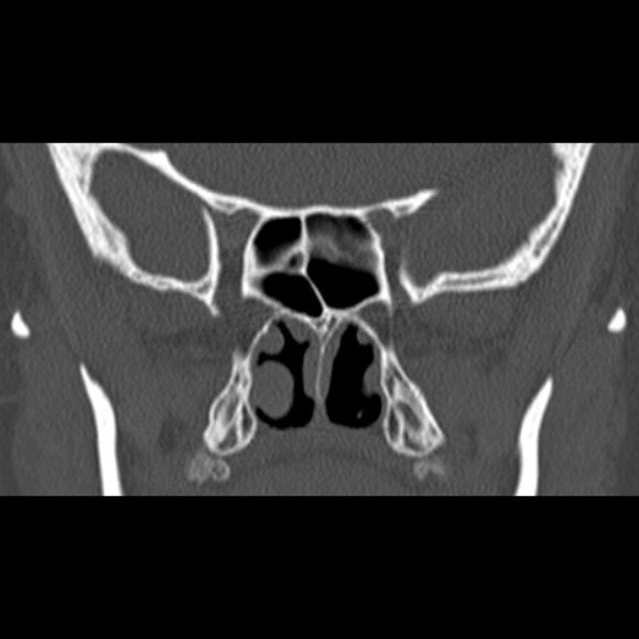 File:Nasal septal perforation (Radiopaedia 25030-25289 Coronal bone window 51).jpg