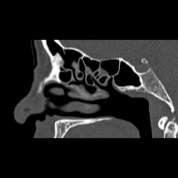Nasal septal perforation (Radiopaedia 25030-25289 Sagittal bone window 37).jpg