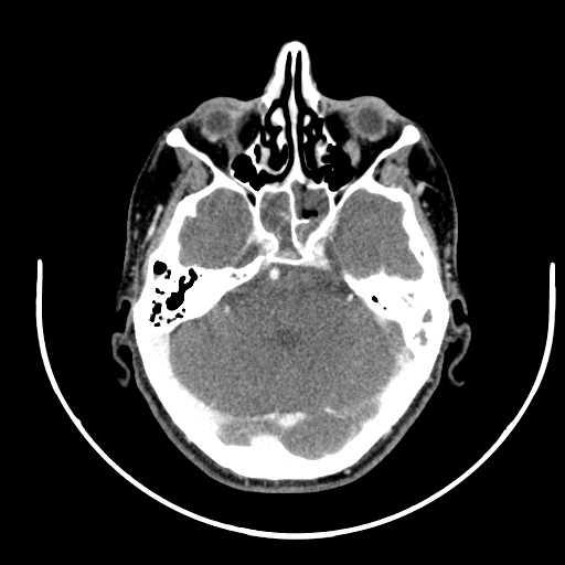 File:Nasopharyngeal carcinoma - infiltrating the clivus (Radiopaedia 62583-70875 Axial Post contrast 7).jpg
