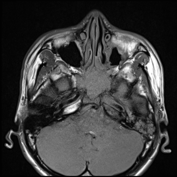Nasopharyngeal carcinoma with skull base invasion (Radiopaedia 53415-59485 Axial T1 22).jpg