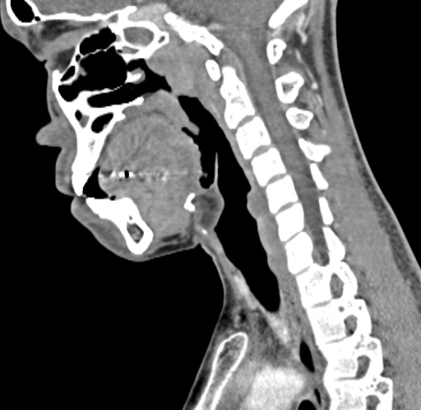 Nasopharyngeal carcinoma with skull base invasion (Radiopaedia 53415-59705 C 33).jpg