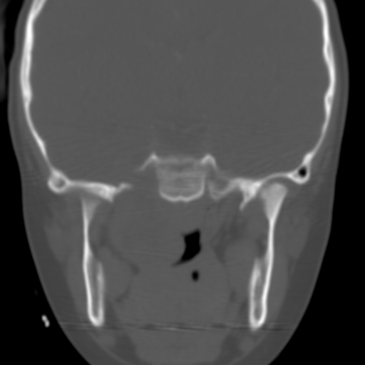 File:Nasopharyngeal rhabdomyosarcoma (Radiopaedia 23417-23491 Coronal bone window 2).jpg