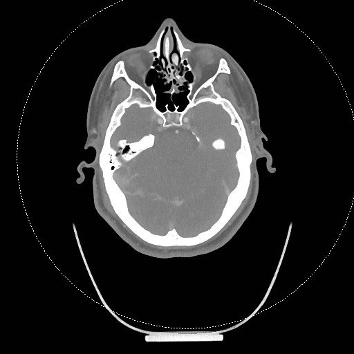 Neck CT angiogram (intraosseous vascular access) (Radiopaedia 55481-61945 B 282).jpg