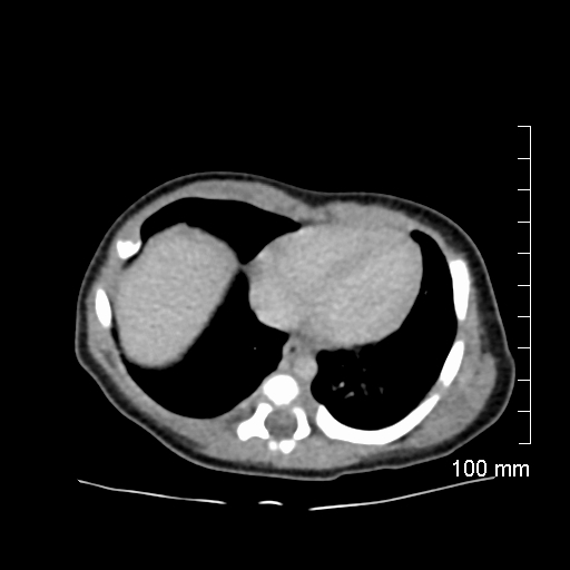File:Neonatal neuroblastoma (Radiopaedia 56651-63438 Axial non-contrast 10).jpg