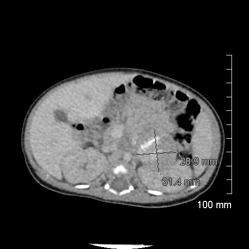 File:Neonatal neuroblastoma (Radiopaedia 56651-63438 Axial non-contrast 32).jpg