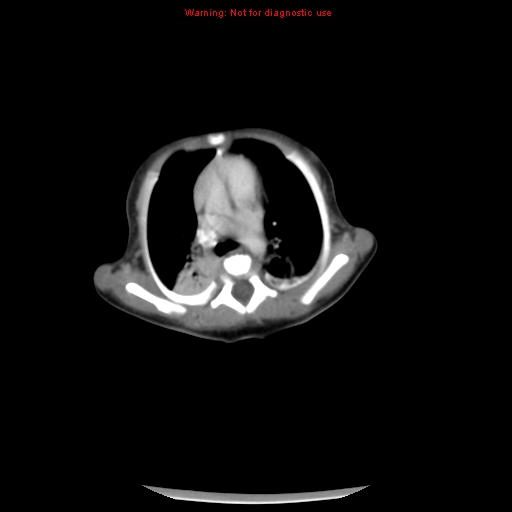 File:Neonatal neuroblastoma (Radiopaedia 9564-10223 A 6).jpg