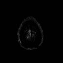 File:Neuro-Behcet's disease (Radiopaedia 21557-21506 Axial DWI 27).jpg