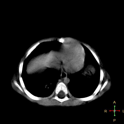 File:Neuroblastoma (Radiopaedia 24751-25016 D 1).jpg