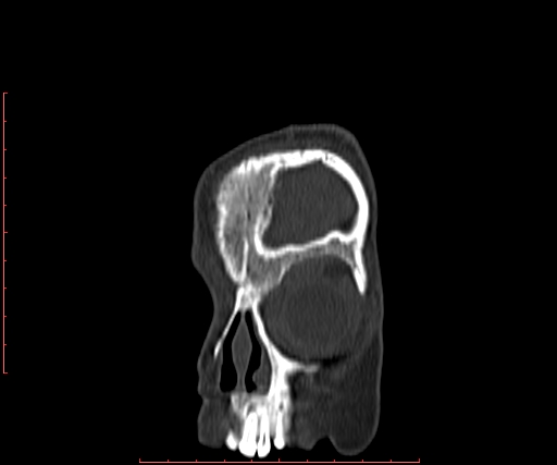 File:Neuroblastoma skull metastasis (Radiopaedia 56053-62683 Coronal bone window 4).jpg