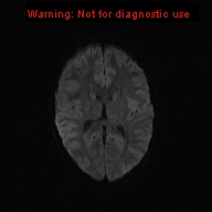 File:Neurofibromatosis type 1 with optic nerve glioma (Radiopaedia 16288-15965 Axial DWI 58).jpg