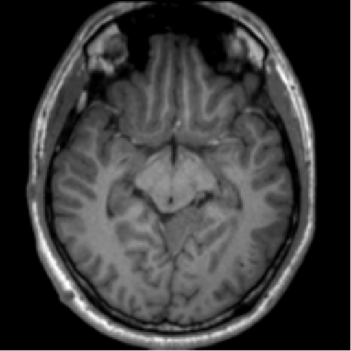 File:Neurofibromatosis type 2 (Radiopaedia 44936-48838 Axial T1 60).png