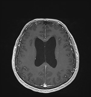 Neurofibromatosis type 2 (Radiopaedia 79097-92049 Axial T1 C+ 127).jpg