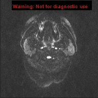 File:Neuroglial cyst (Radiopaedia 10713-11184 Axial DWI 46).jpg